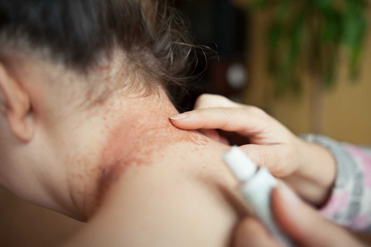 Eczema Relief and Skin-Calming Solutions