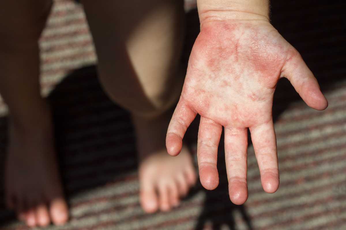 Biologic Therapies for Autoimmune Disorders